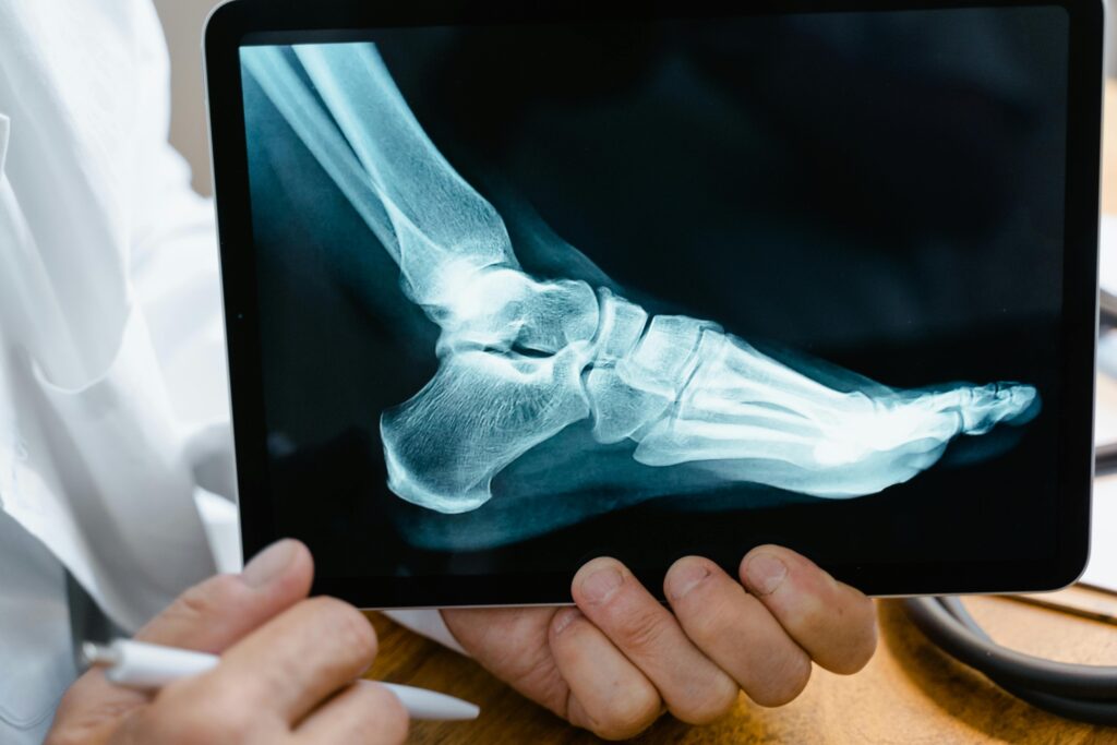 Have a personal injury claim in Douglasville, GA? Get tips from a personal injury doctor. Image of x-ray of foot. 